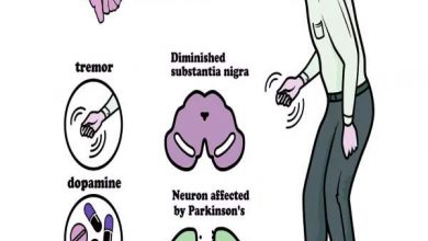 بیماری پارکینسون PD یا لقوه در مغز و اعصاب